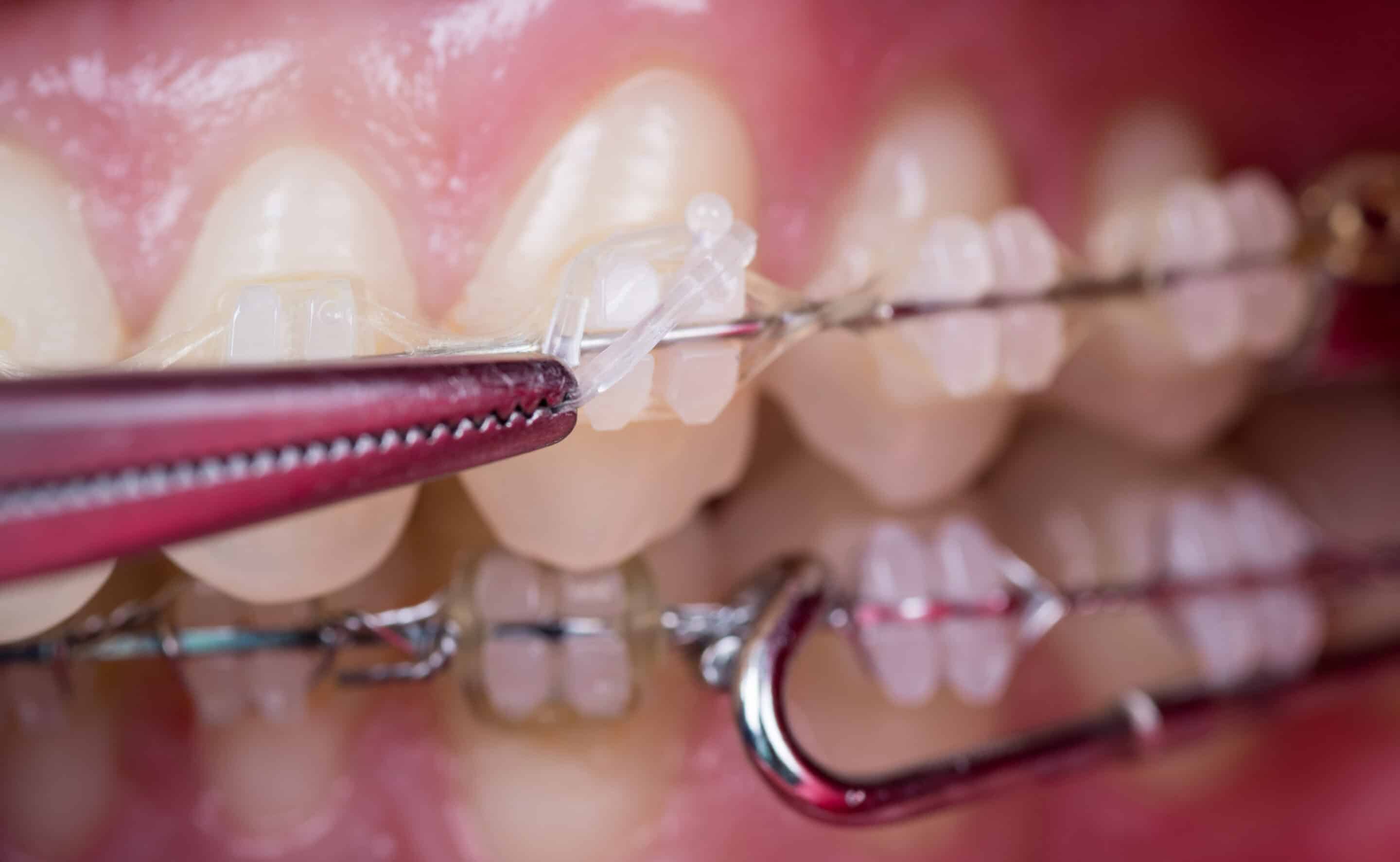 Dentist treating teeth with ceramic brackets, using mosquito at the dental office. Clinic, office and dentist with tablet for medical service, appointment schedule and research. Heal