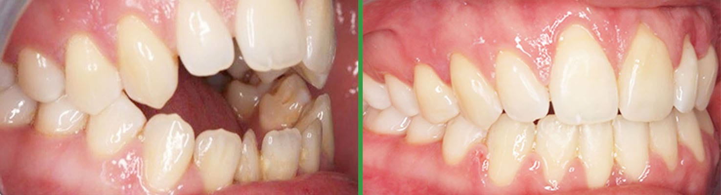 Bright Smiles before and after dental result 2