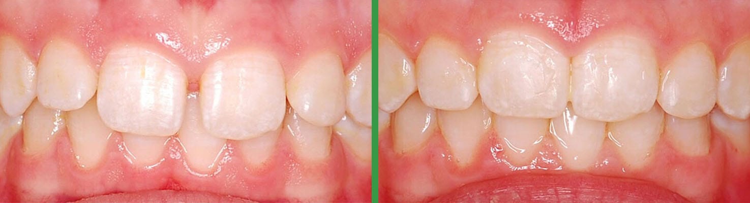 Bright Smiles before and after dental result 3