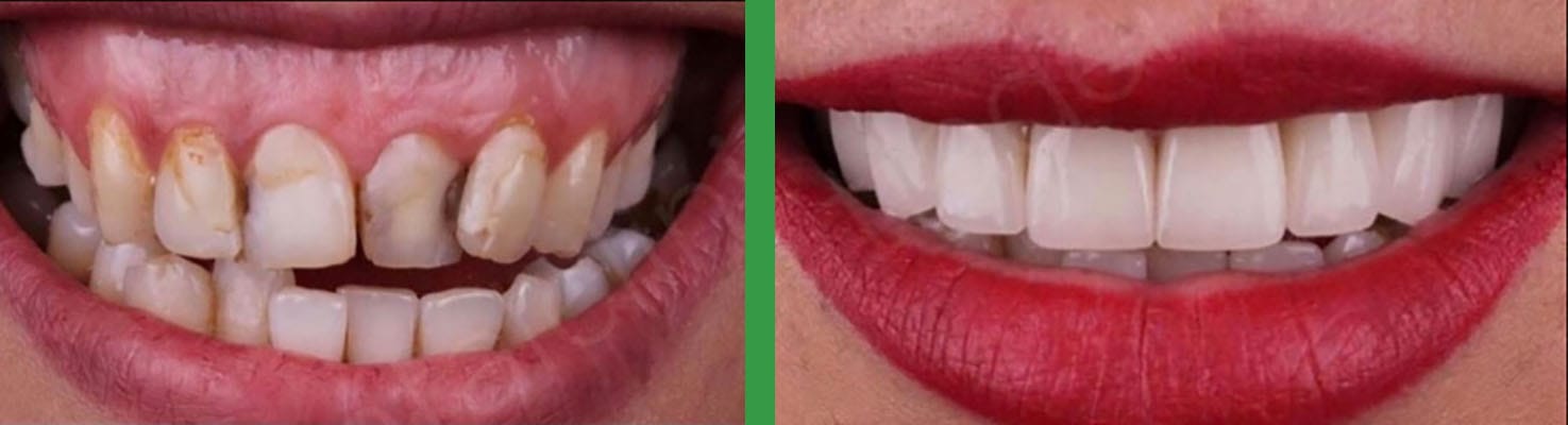 Bright Smiles before and after dental result 5