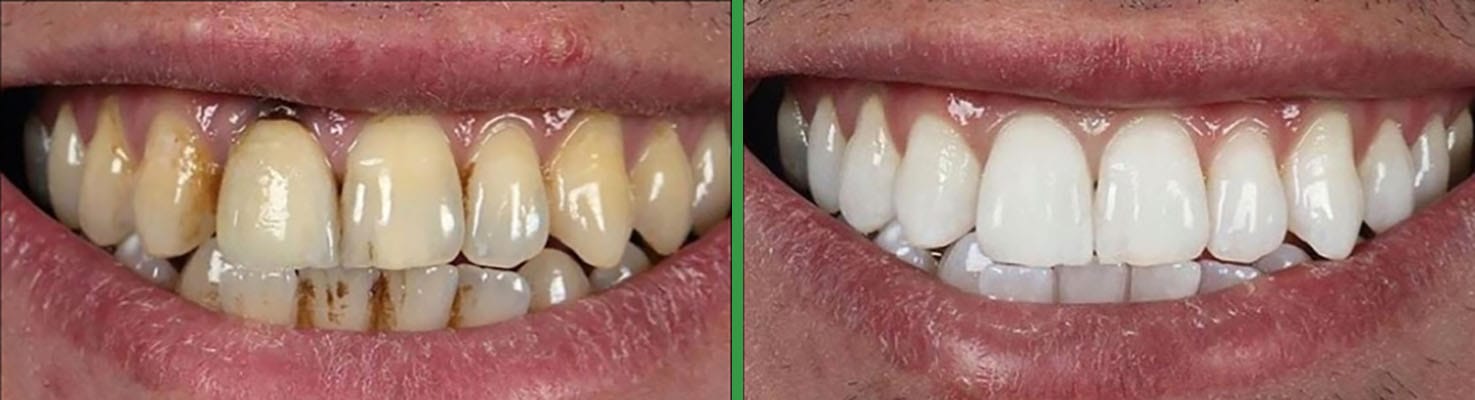 Bright Smiles before and after dental result 4