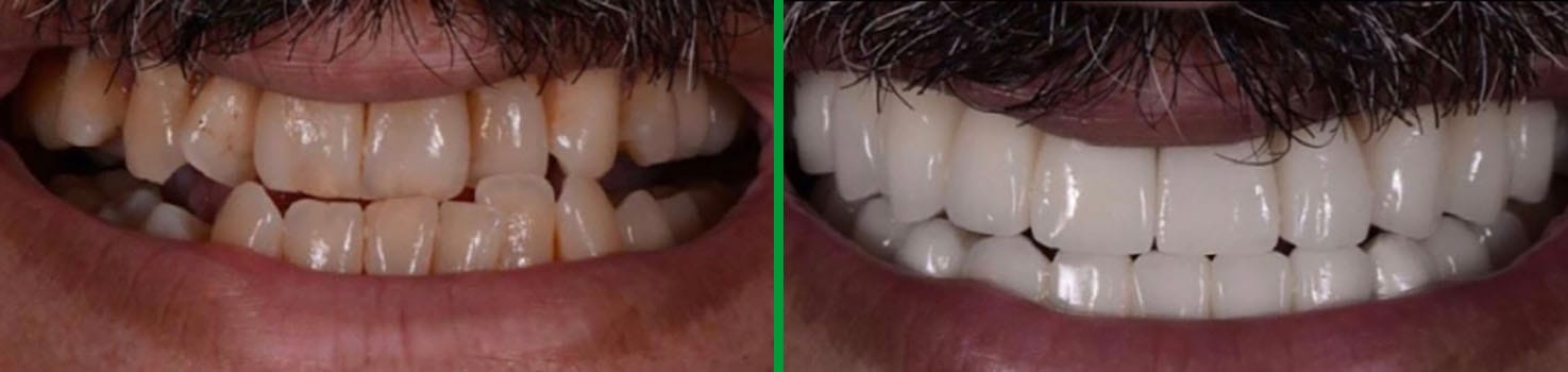 Bright Smiles before and after dental result 1