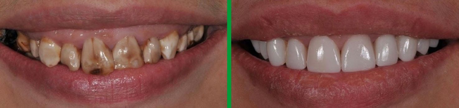 Bright Smiles before and after dental result 6
