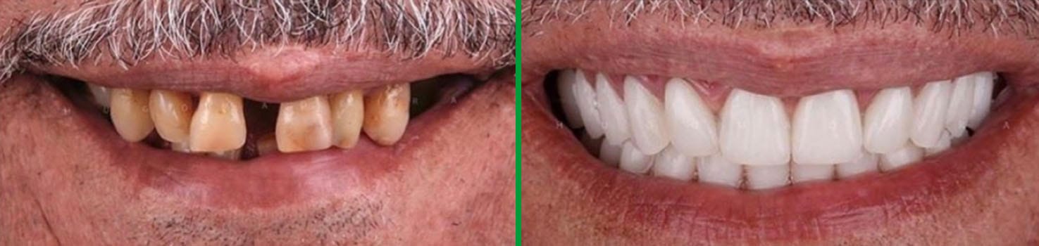 Bright Smiles before and after dental result 7