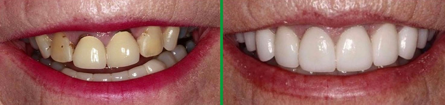 Bright Smiles before and after dental result 8