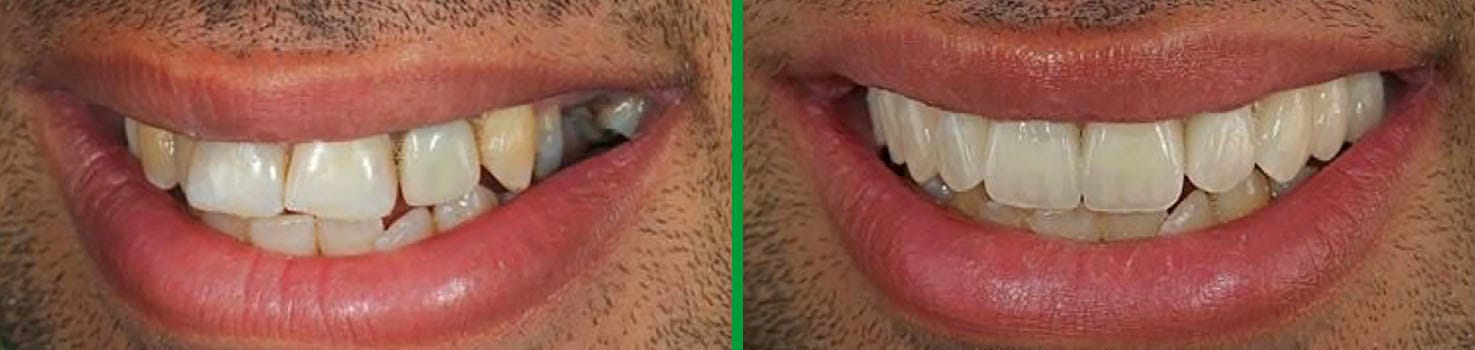 Bright Smiles before and after dental result 9