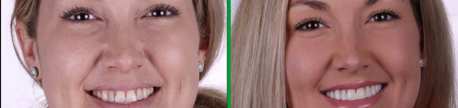 Bright Smiles before and after dental result 10