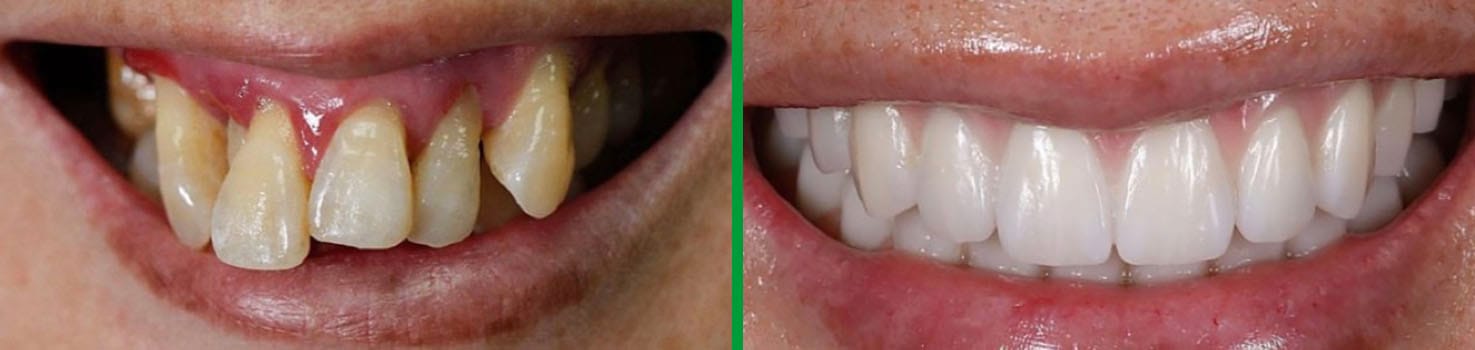Bright Smiles before and after dental result 11