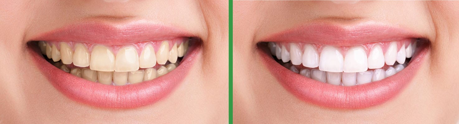 Bright Smiles before and after dental result 12