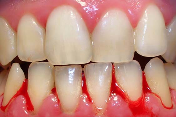 Dentist performing laser teeth whitening procedure on patient