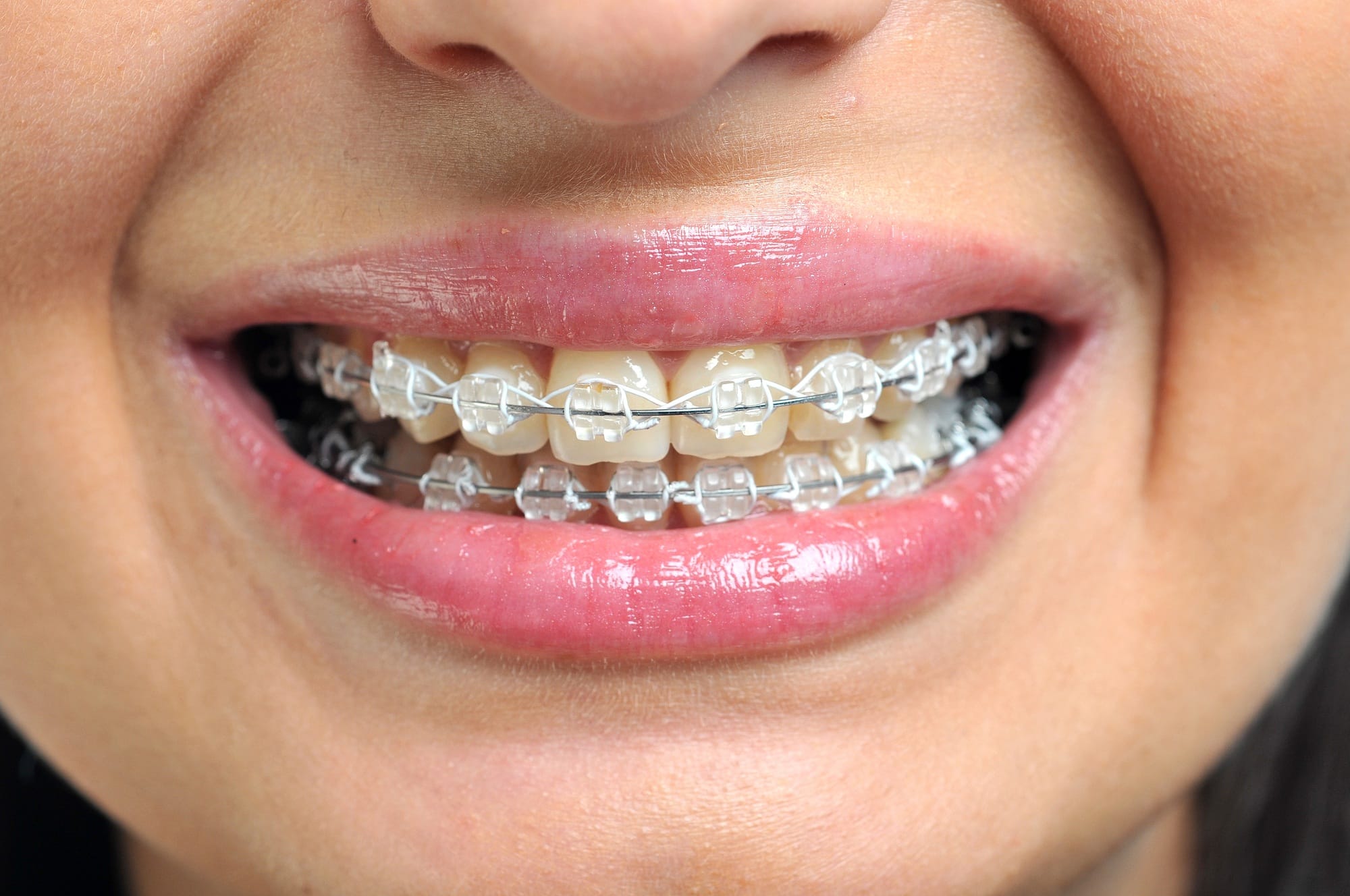 Close-up of ceramic and metallic braces on teeth. Orthodontic Treatment. Dental Care Concept Close-up of ceramic and metallic braces on teeth. Orthodontic Treatment. Dental Care Concept