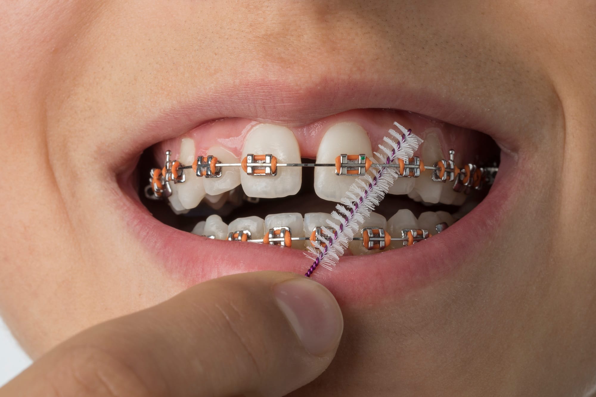 Close up of cleaning dental braces Close up of cleaning dental braces