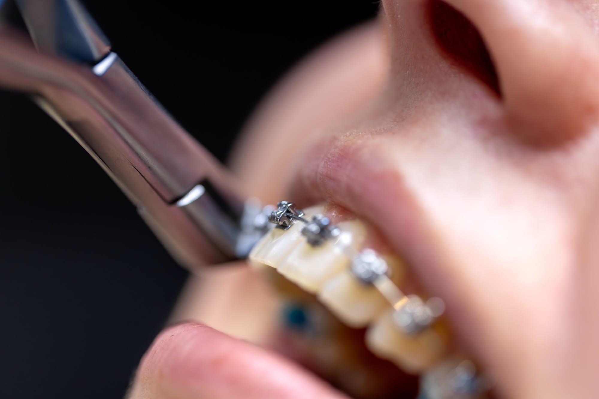 Dental procedure for installing braces close up. Dentistry. Braces on the teeth. Dental procedure for installing braces close up. Dentistry. Braces on the teeth.