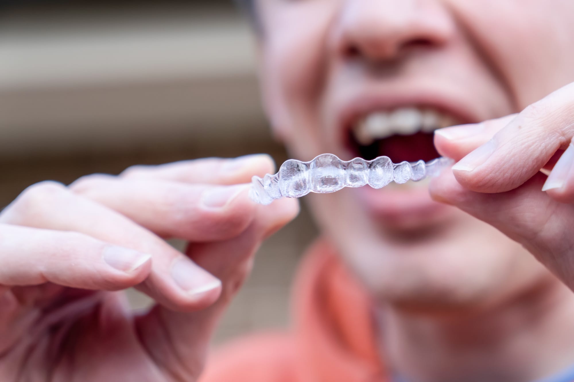 Man holds put on invisible braces. Invisalign plastic removable braces