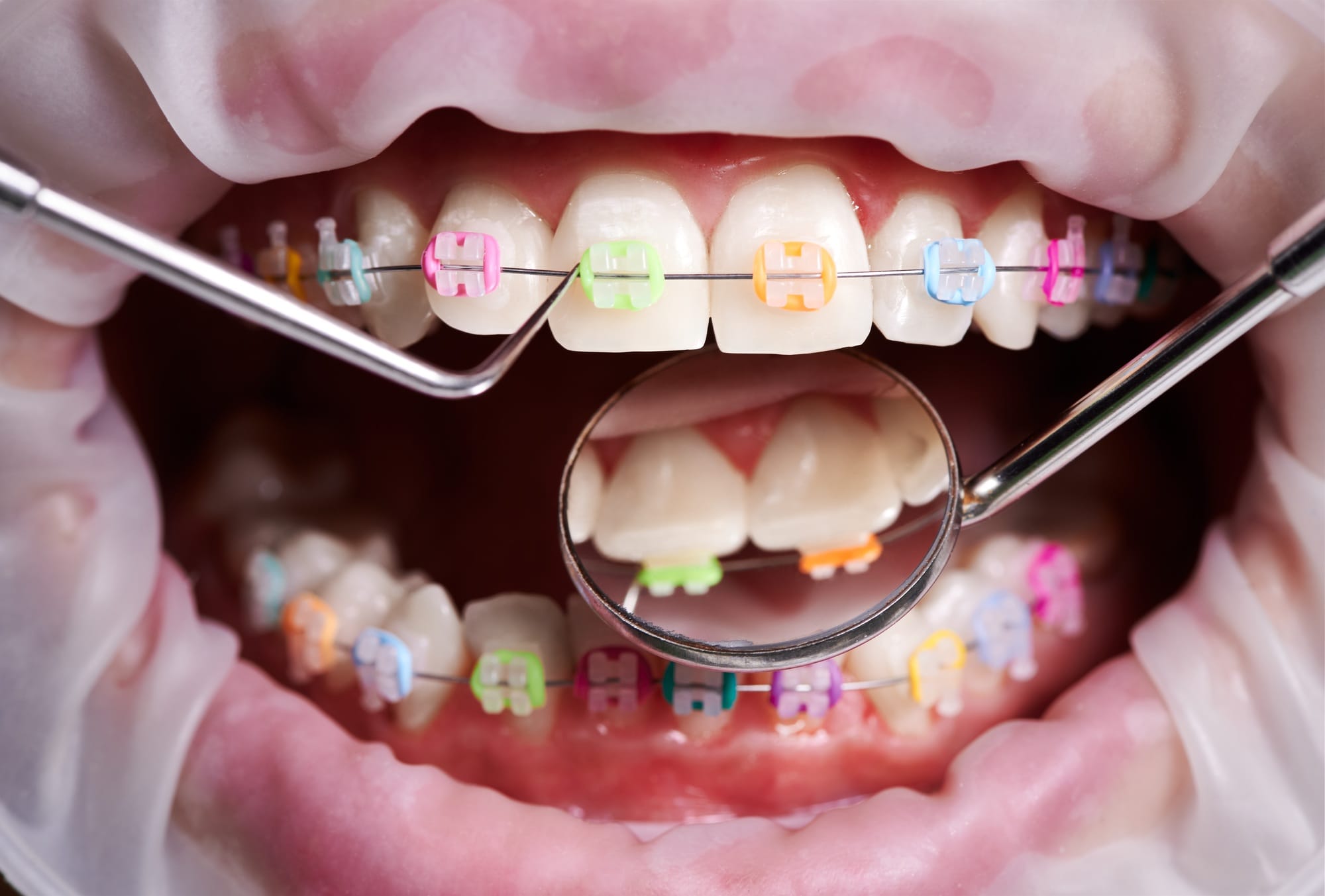 Orthodontist examining patient braces with dental instruments. Orthodontist examining patient braces with dental instruments.