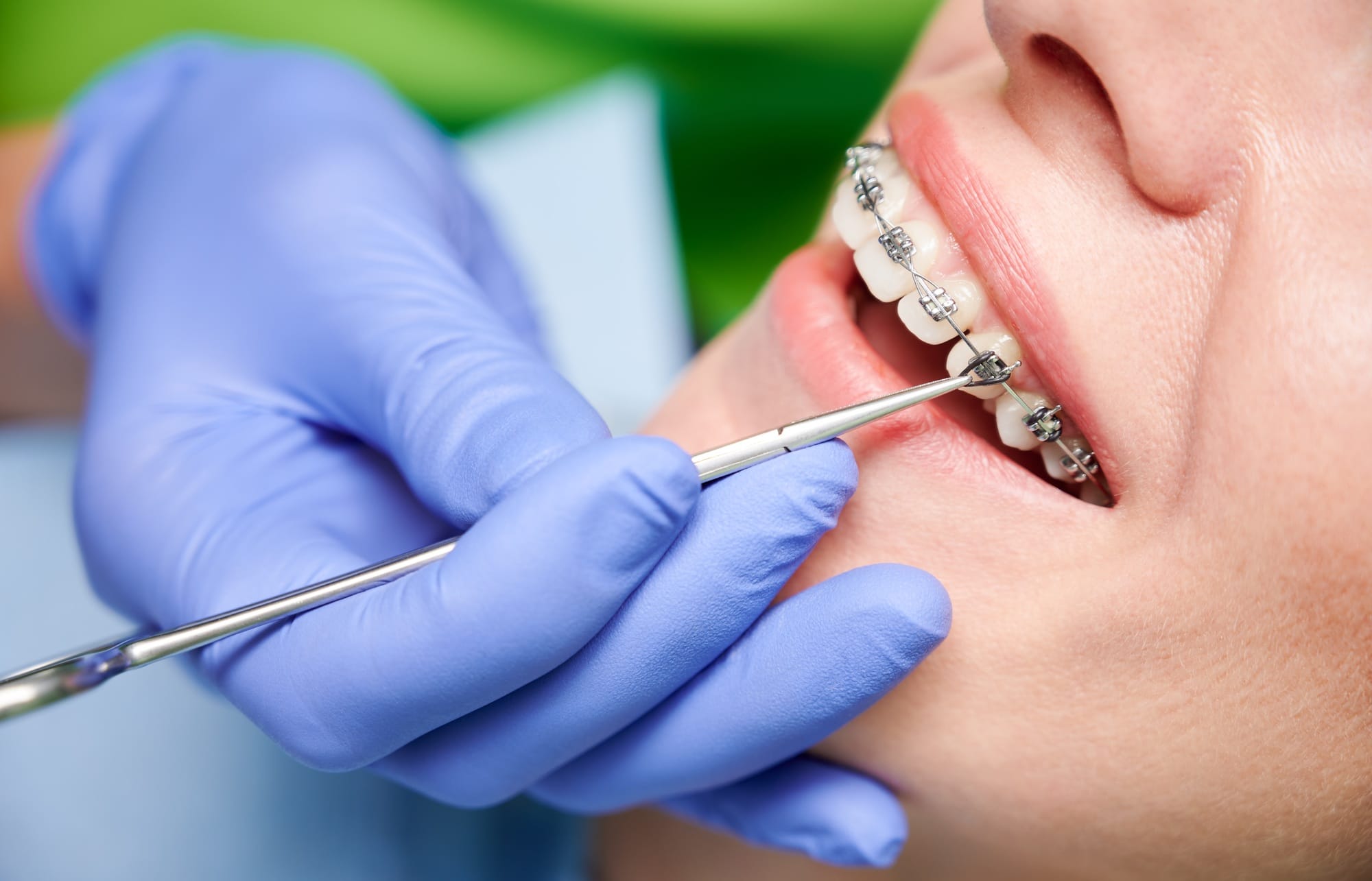 Orthodontist hands placing braces on woman teeth. Orthodontist hands placing braces on woman teeth.