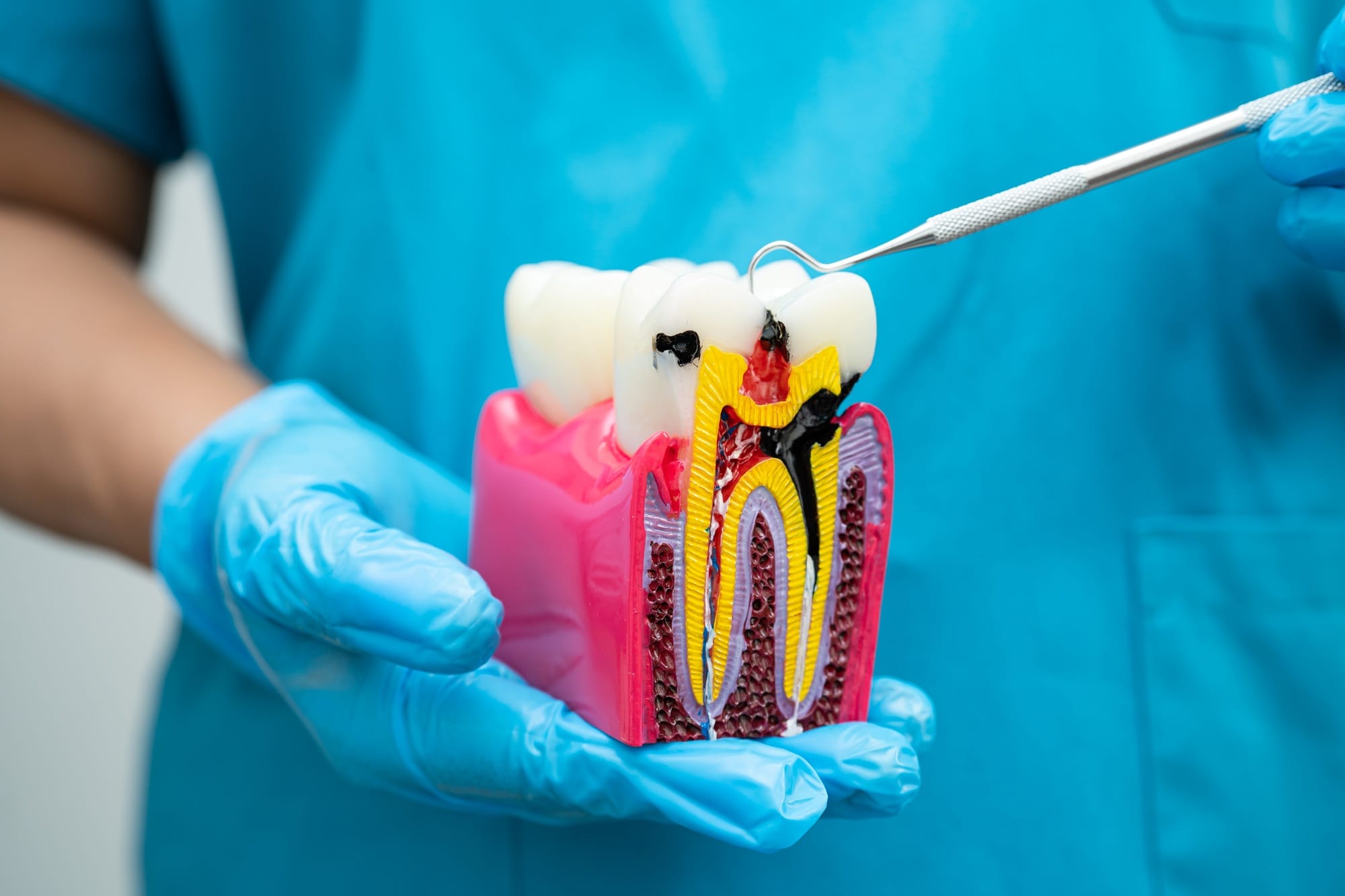 Asian dentist holding dental implant, artificial tooth roots into jaw, root canal Asian dentist holding dental implant, artificial tooth roots into jaw, root canal