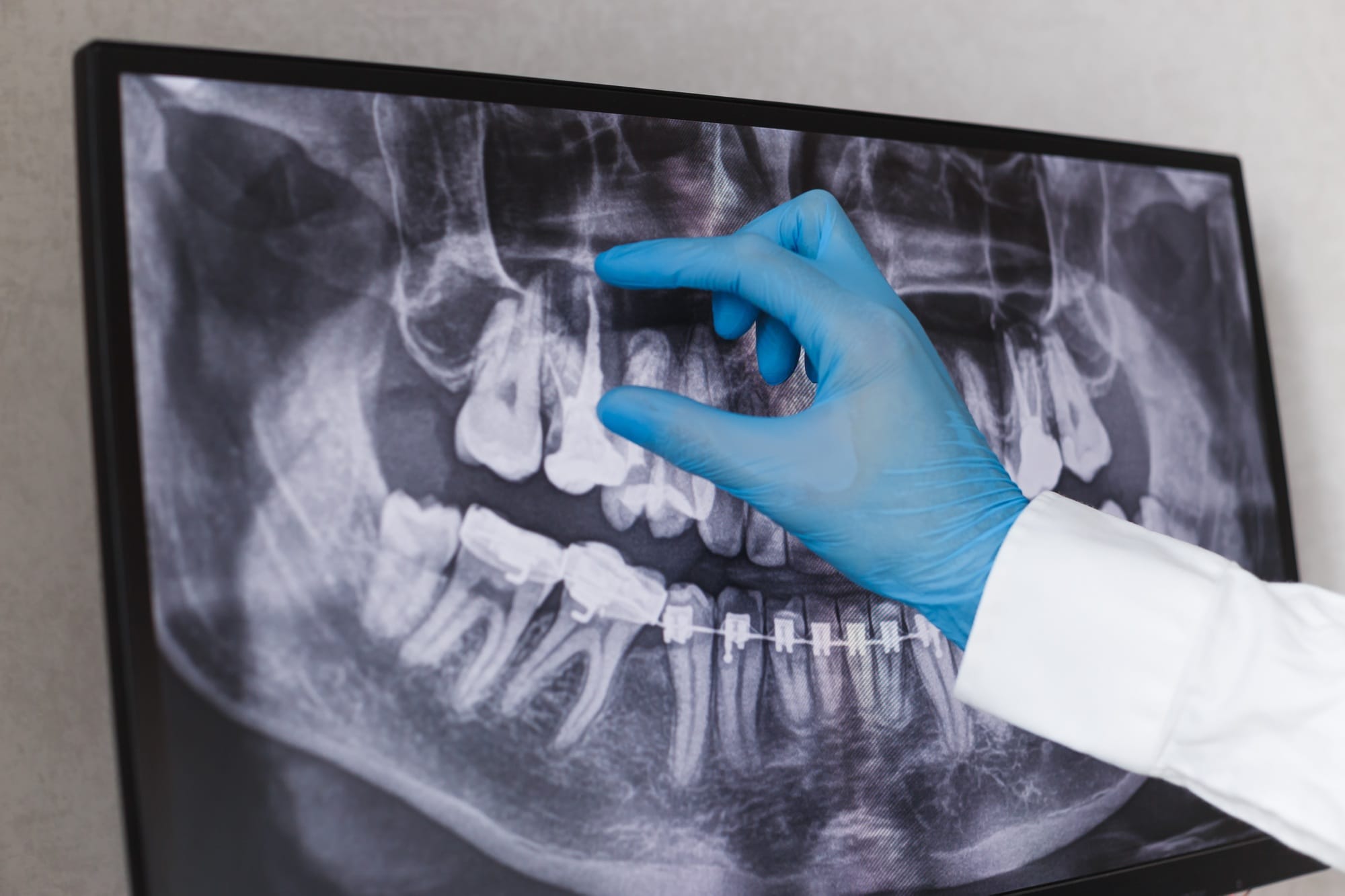 Doctor points to filled root canal in dental x-ray Doctor points to filled root canal in dental x-ray
