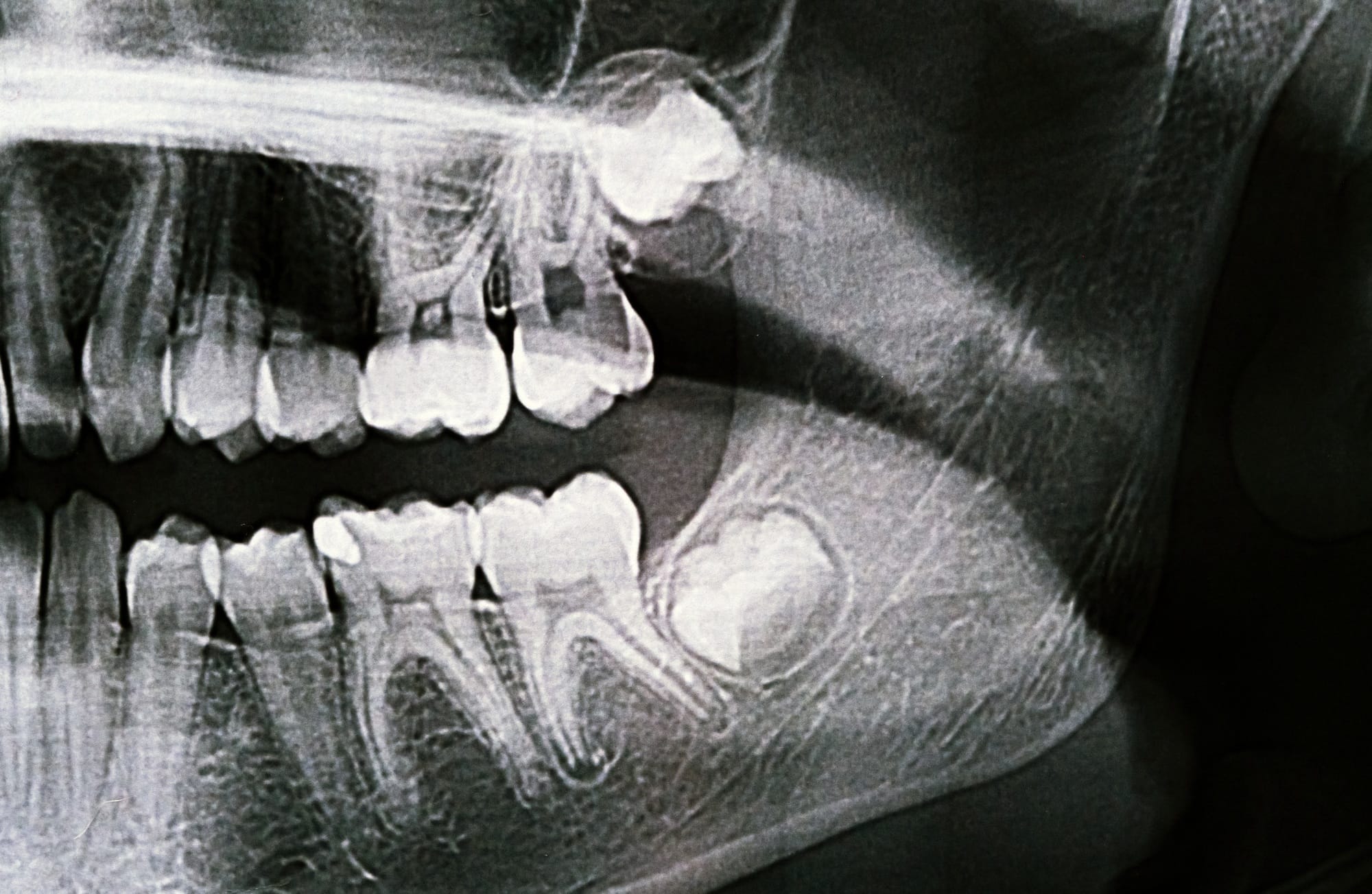 Panoramic X-ray of the jaw. X-ray of the teeth of a 12-year-old girl Panoramic X-ray of the jaw. X-ray of the teeth of a 12-year-old girl