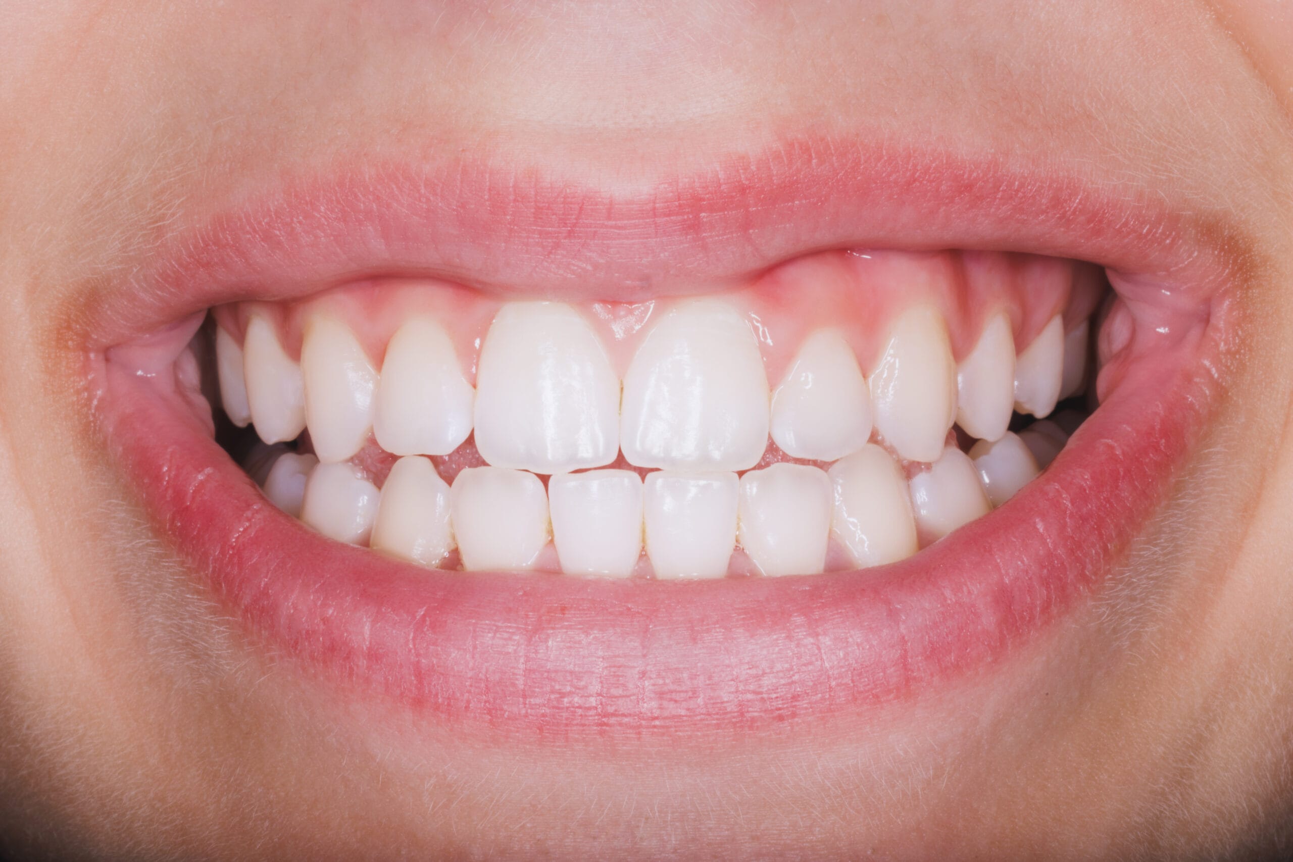 Close Up Of A Teeth Smiling Mouth Of A Woman Sedation Dentistry