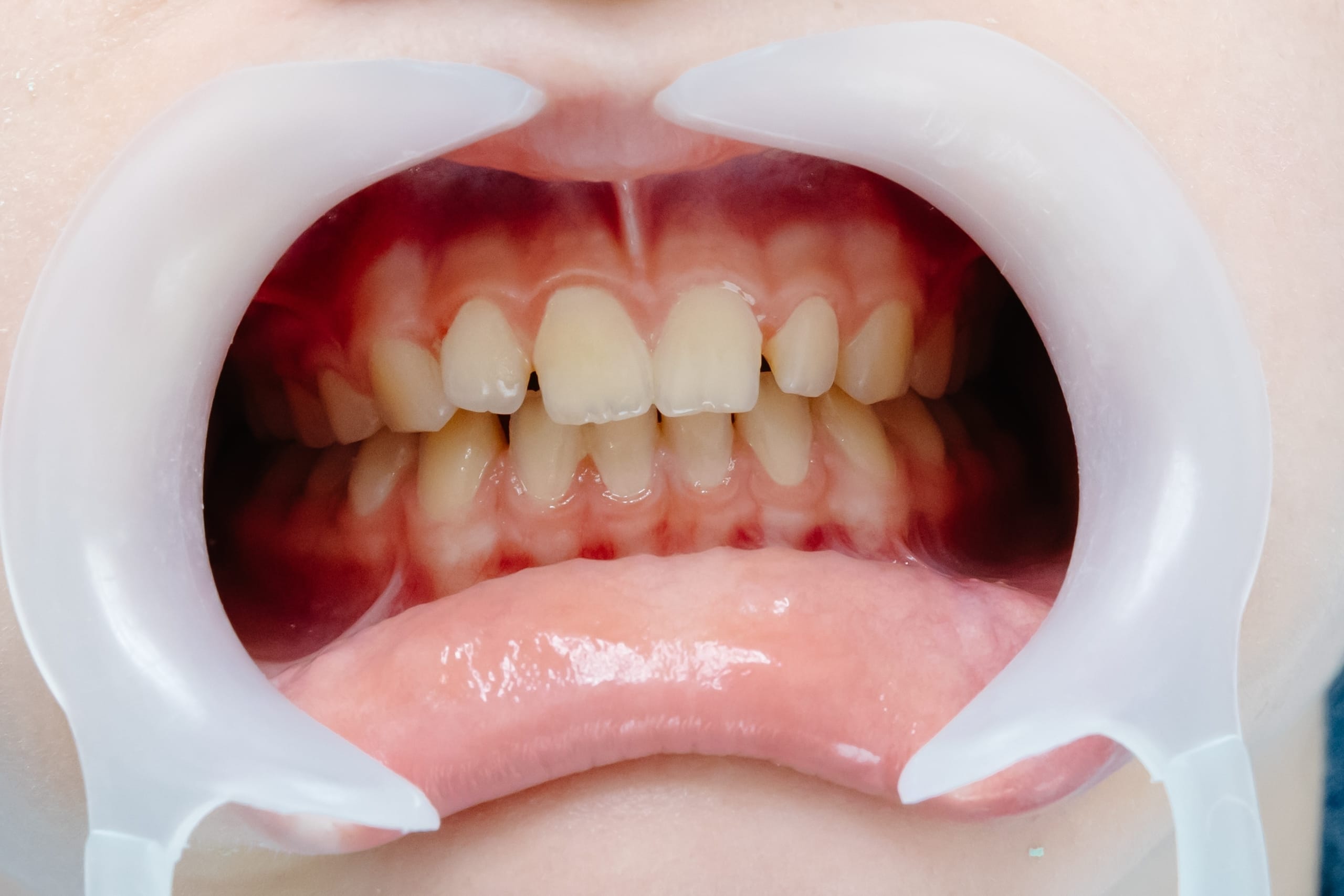 Open mouth showing teeth during dental checkup Caucasian girl with braces on her teeth looking at the mirror.