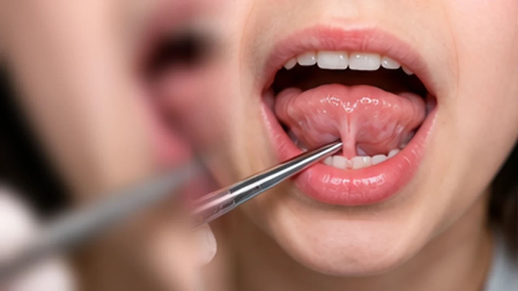Lingual Frenectomy at Bright Smiles