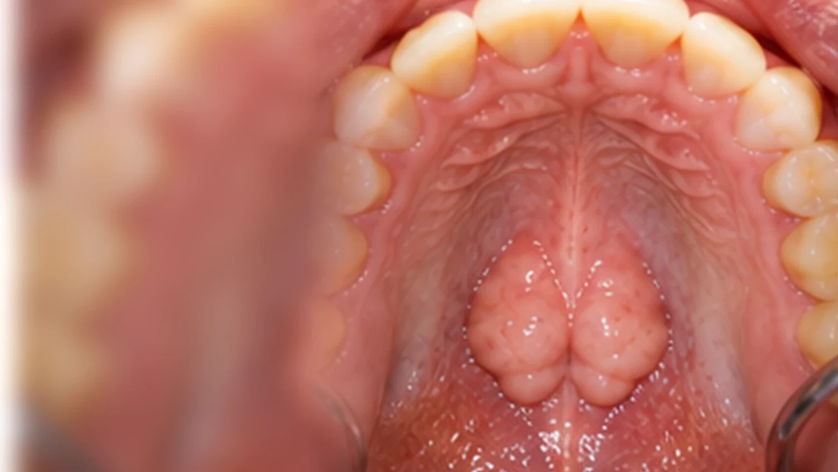Tori Removal at Bright Smiles